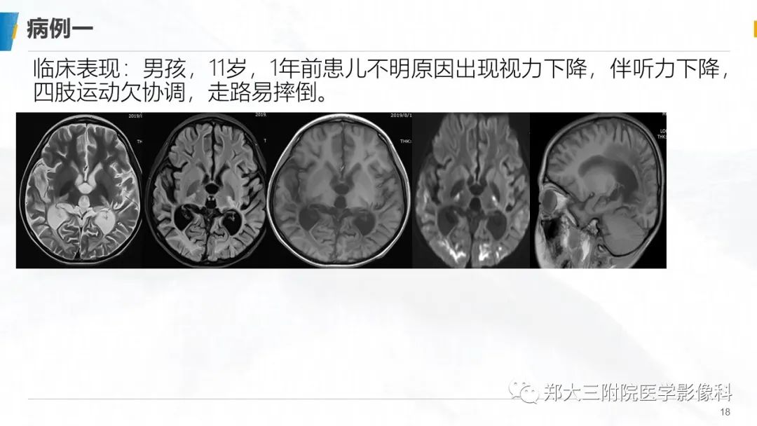 影像PPT - 【PPT】肾上腺脑白质营养不良影像诊断-18