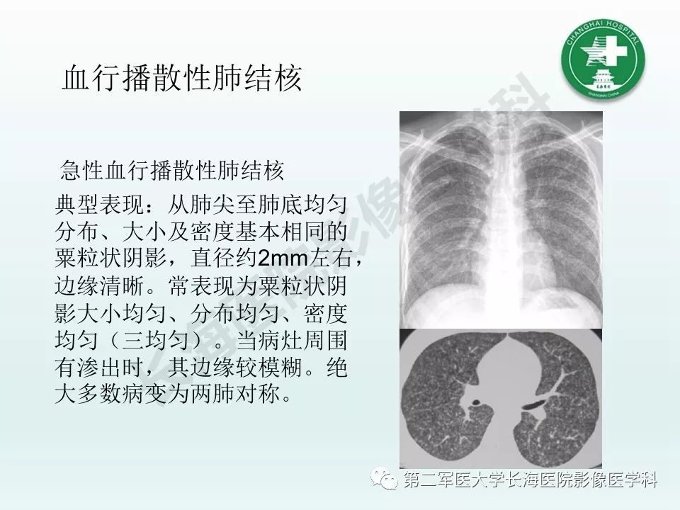 影像PPT - 【PPT】结核影像诊断-11 影像PPT - 【PPT】结核影像诊断-11