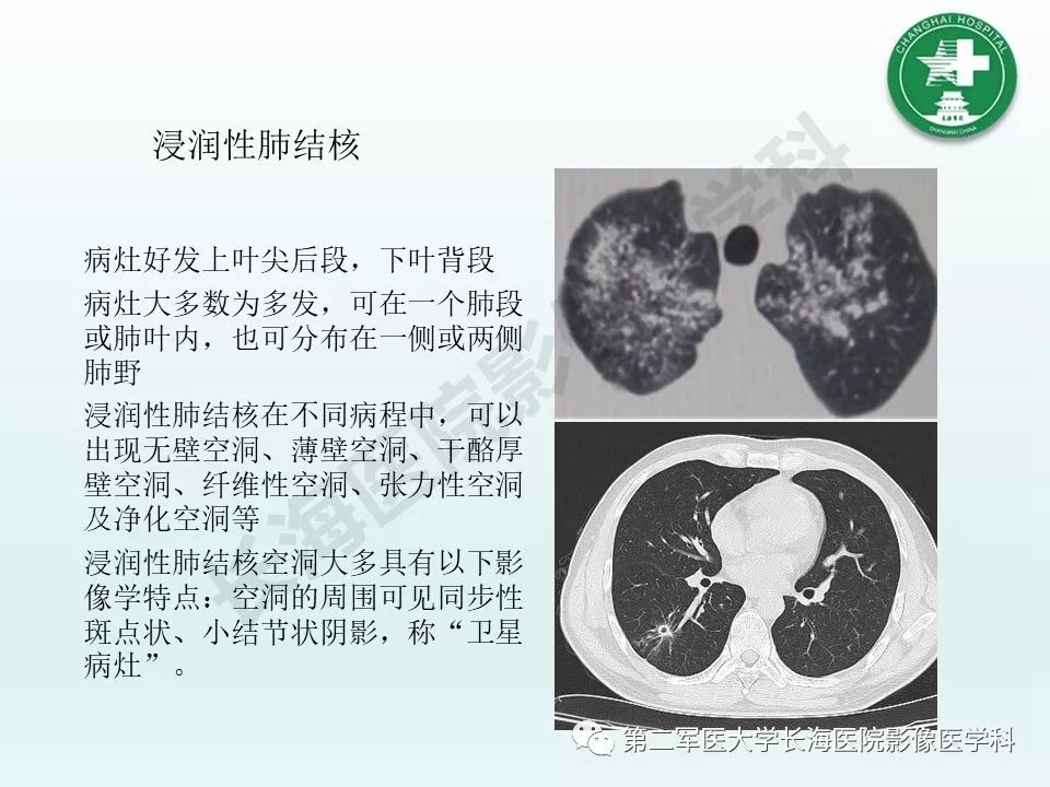 影像PPT - 【PPT】结核影像诊断-14 影像PPT - 【PPT】结核影像诊断-14