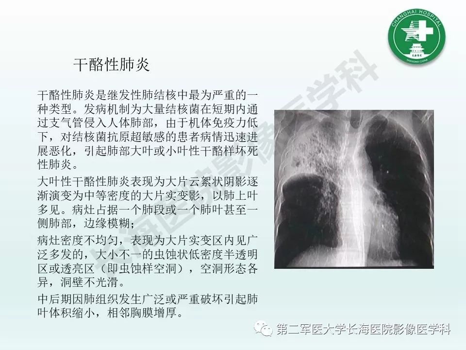 影像PPT - 【PPT】结核影像诊断-15 影像PPT - 【PPT】结核影像诊断-15