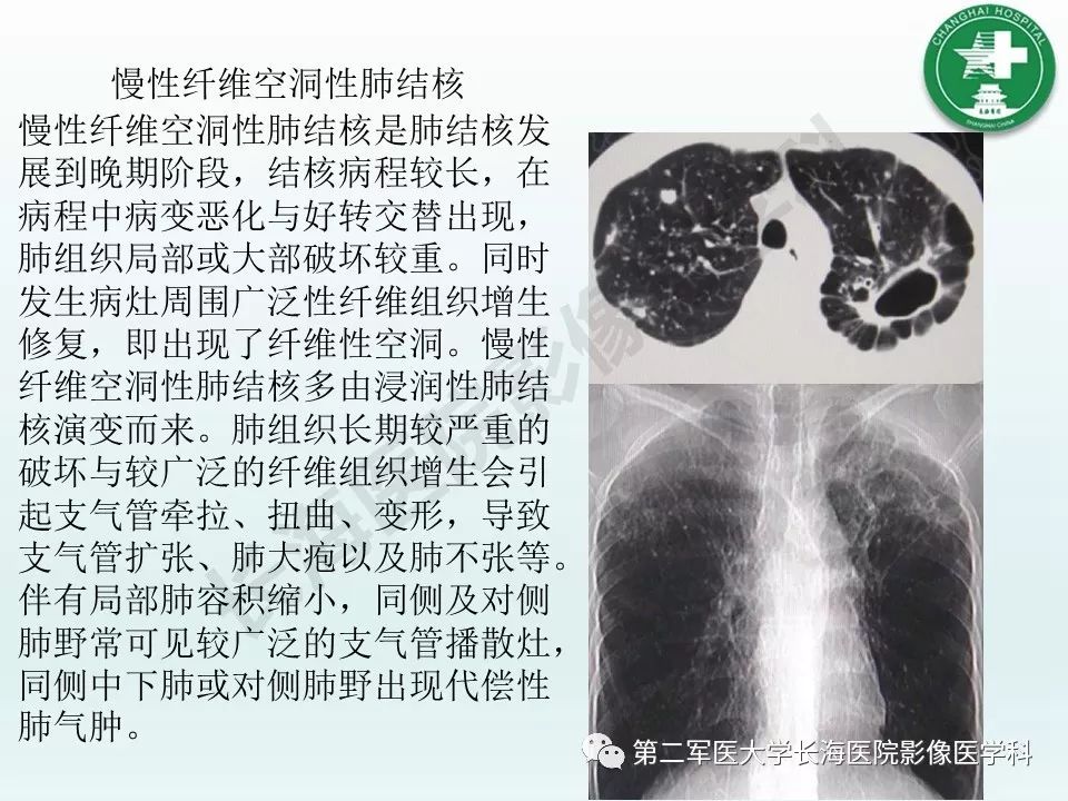 影像PPT - 【PPT】结核影像诊断-17 影像PPT - 【PPT】结核影像诊断-17