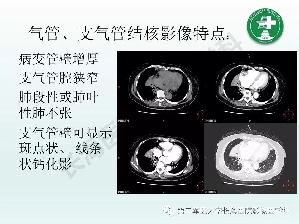 影像PPT - 【PPT】结核影像诊断-19 影像PPT - 【PPT】结核影像诊断-19
