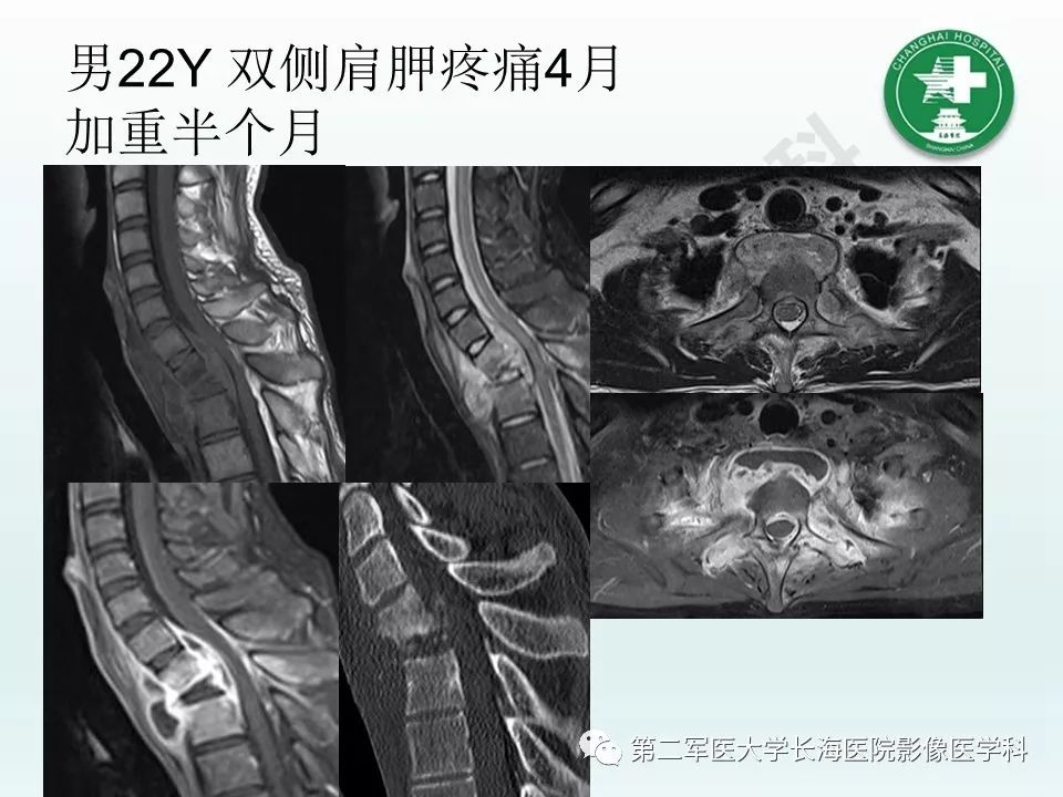 影像PPT - 【PPT】结核影像诊断-23 影像PPT - 【PPT】结核影像诊断-23