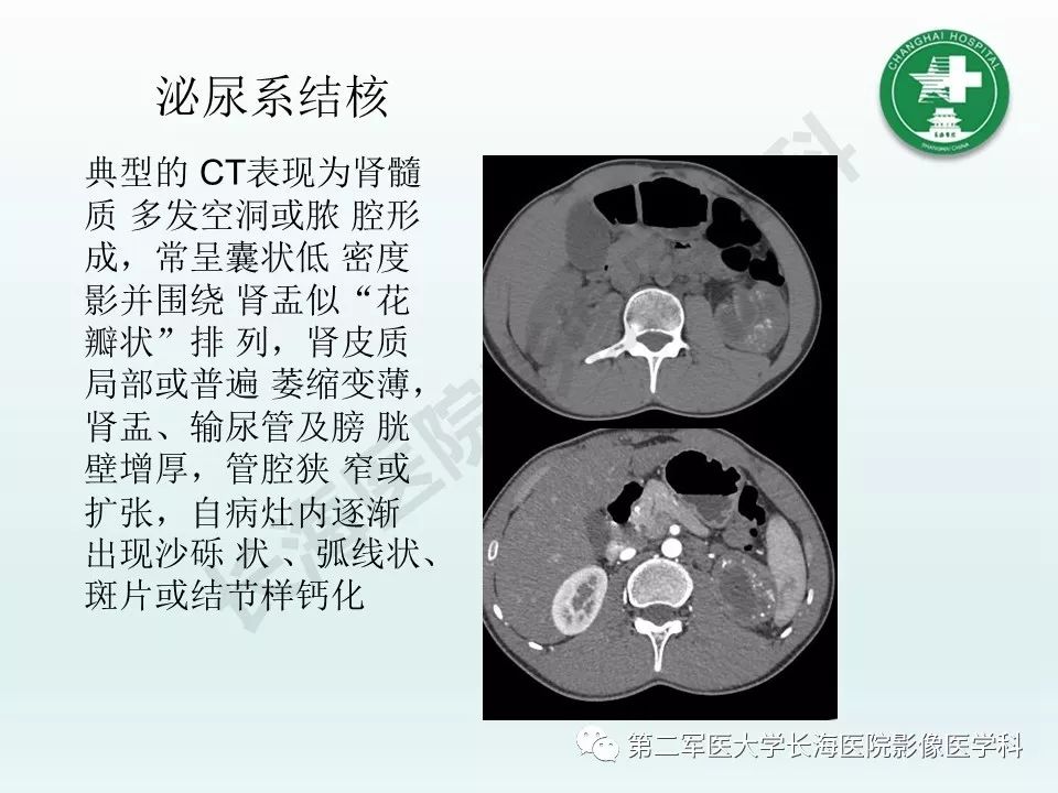 影像PPT - 【PPT】结核影像诊断-24 影像PPT - 【PPT】结核影像诊断-24