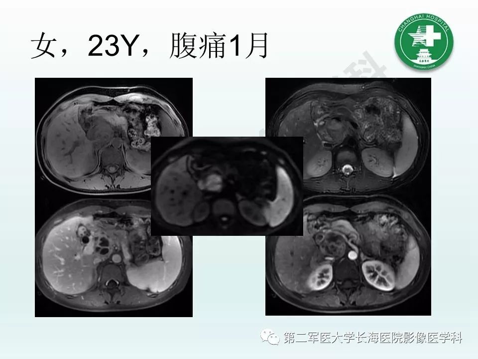影像PPT - 【PPT】结核影像诊断-26 影像PPT - 【PPT】结核影像诊断-26