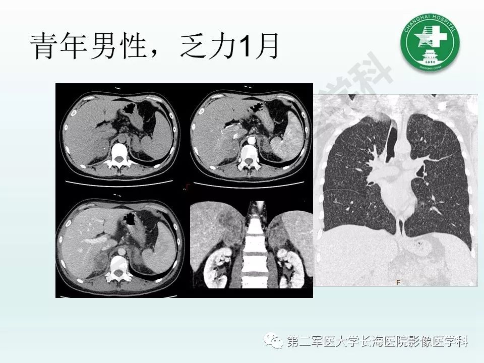 影像PPT - 【PPT】结核影像诊断-27 影像PPT - 【PPT】结核影像诊断-27