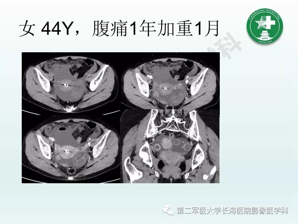 影像PPT - 【PPT】结核影像诊断-29 影像PPT - 【PPT】结核影像诊断-29