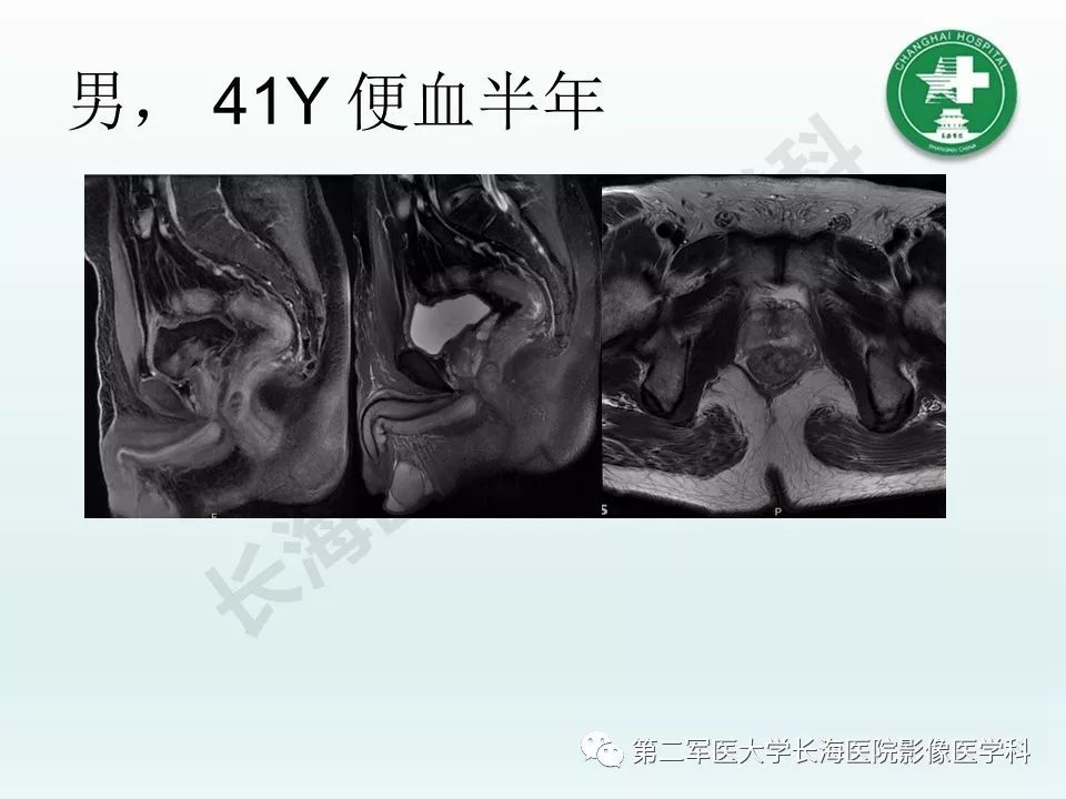 影像PPT - 【PPT】结核影像诊断-30 影像PPT - 【PPT】结核影像诊断-30