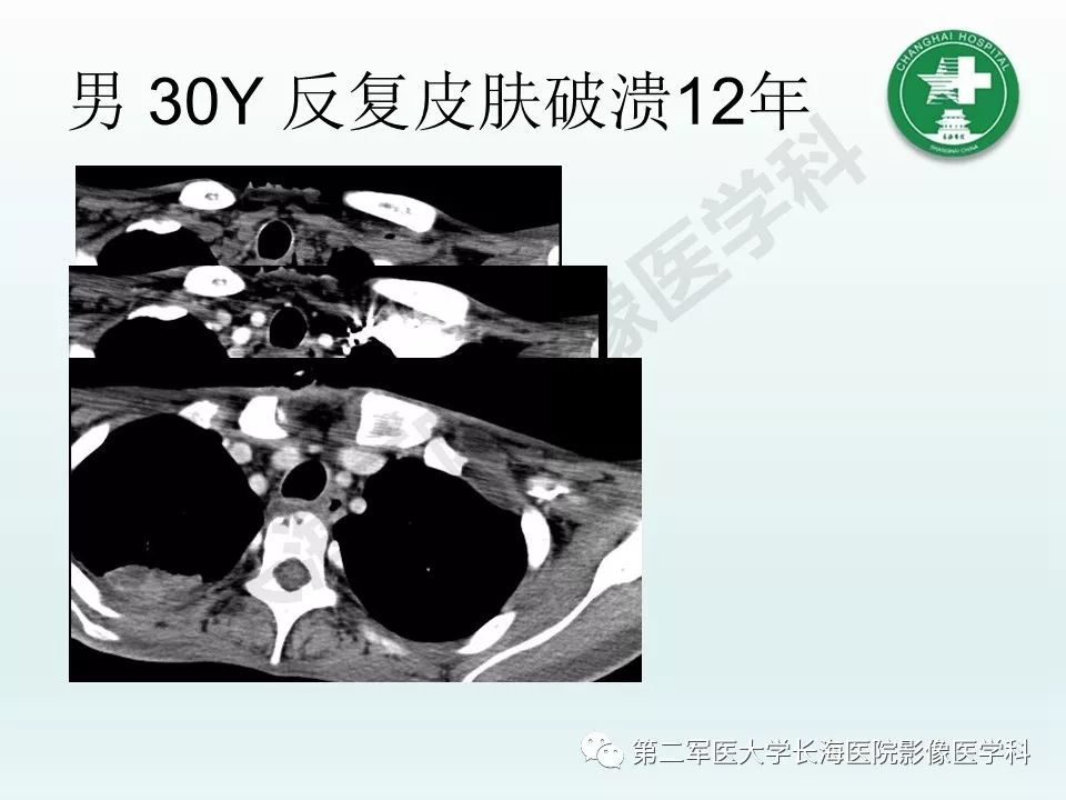 影像PPT - 【PPT】结核影像诊断-32 影像PPT - 【PPT】结核影像诊断-32