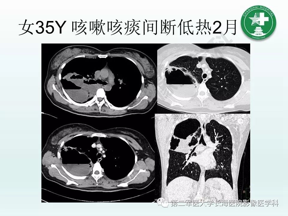 影像PPT - 【PPT】结核影像诊断-34 影像PPT - 【PPT】结核影像诊断-34