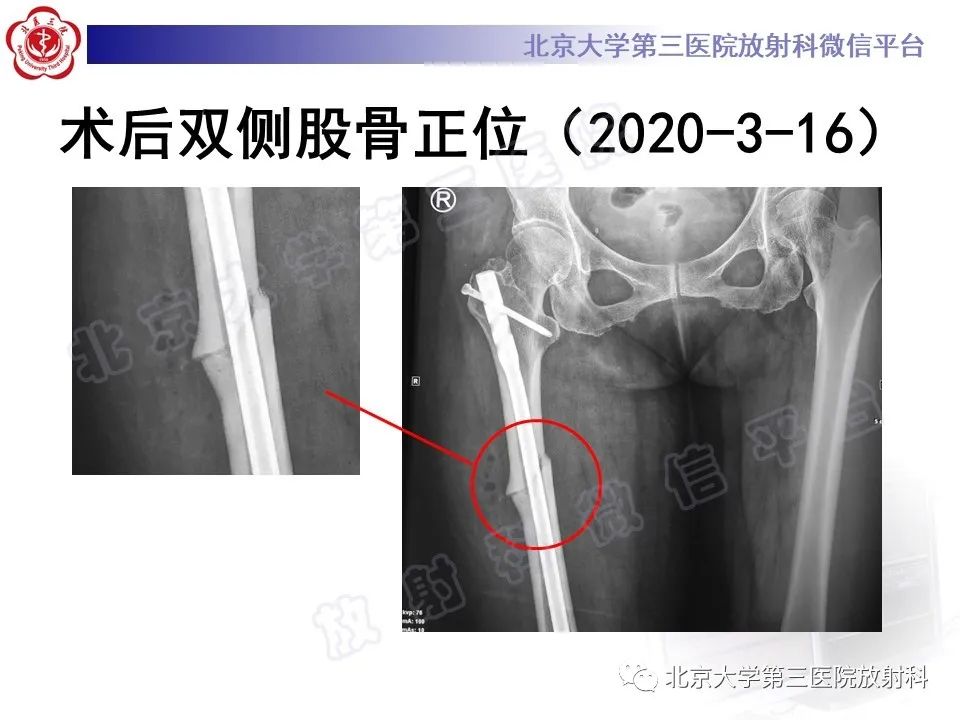 影像PPT - 【PPT】非典型股骨骨折-5