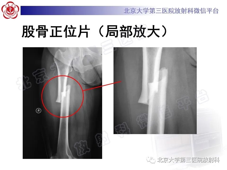 影像PPT - 【PPT】非典型股骨骨折-4