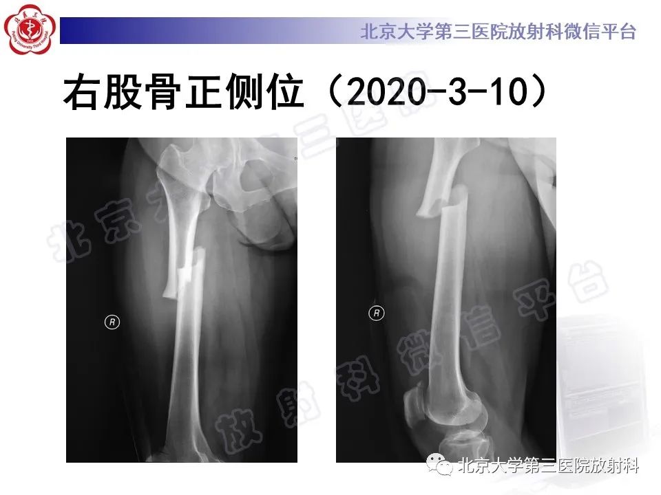 影像PPT - 【PPT】非典型股骨骨折-3
