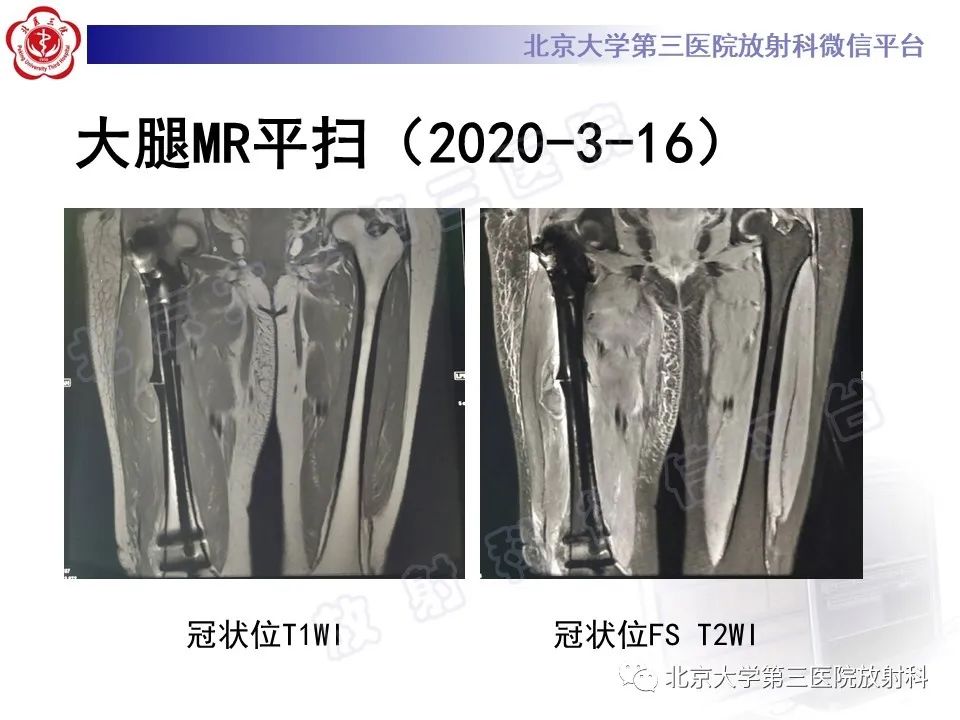 影像PPT - 【PPT】非典型股骨骨折-6