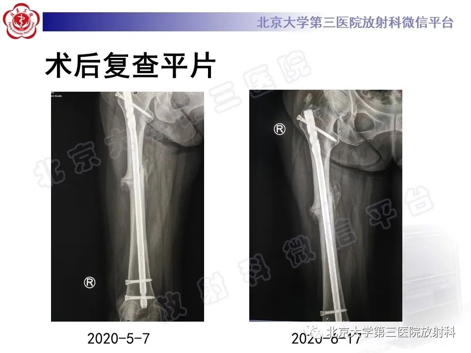 影像PPT - 【PPT】非典型股骨骨折-7