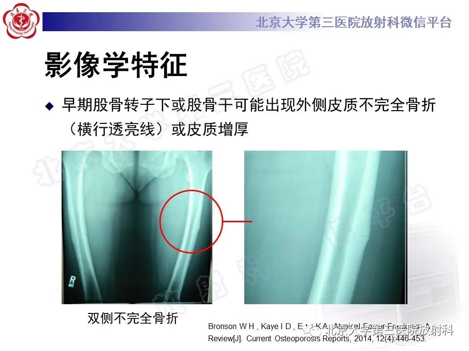 影像PPT - 【PPT】非典型股骨骨折-19