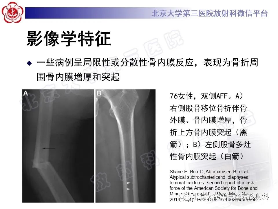 影像PPT - 【PPT】非典型股骨骨折-20