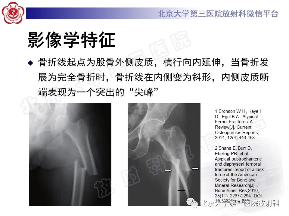 影像PPT - 【PPT】非典型股骨骨折-21