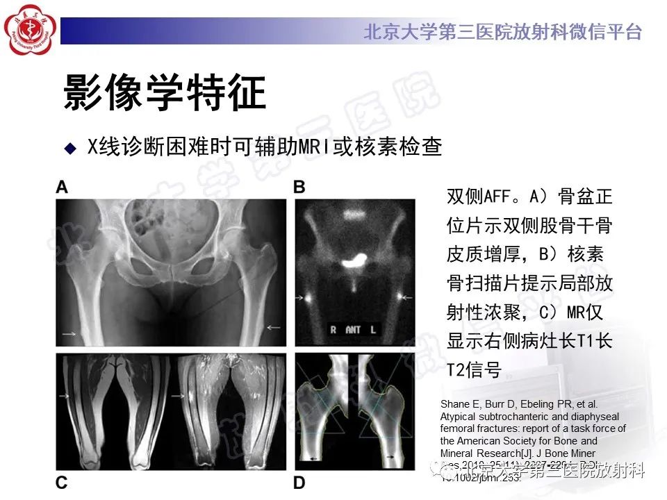 影像PPT - 【PPT】非典型股骨骨折-22