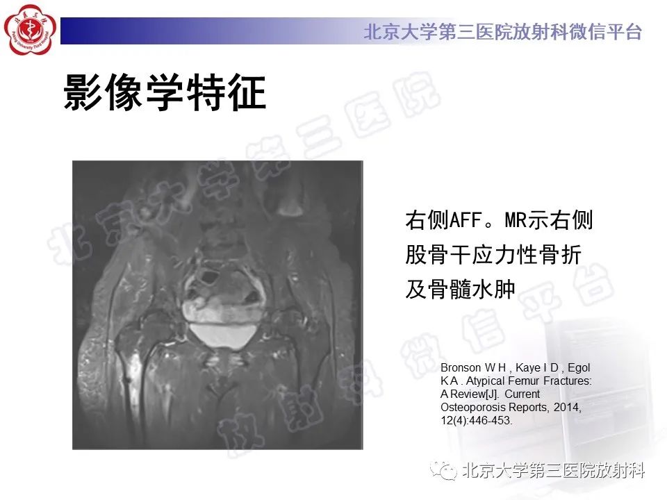 影像PPT - 【PPT】非典型股骨骨折-23