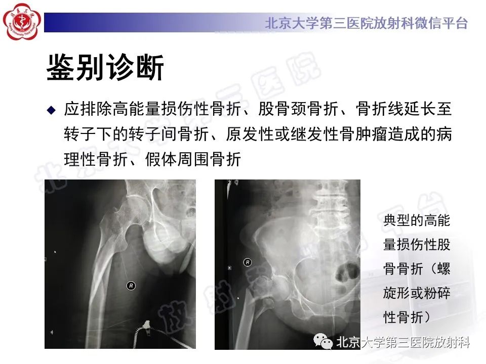 影像PPT - 【PPT】非典型股骨骨折-24
