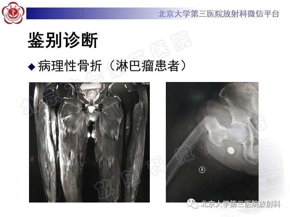 影像PPT - 【PPT】非典型股骨骨折-25