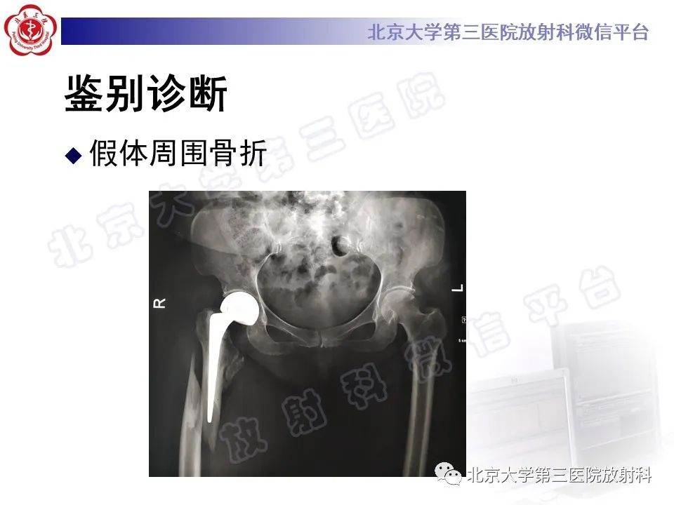 影像PPT - 【PPT】非典型股骨骨折-26