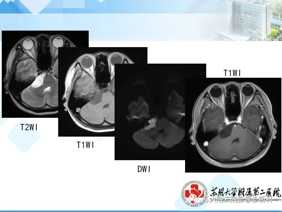 影像PPT - 【PPT】脑桥小脑角区常见占位性病变-6