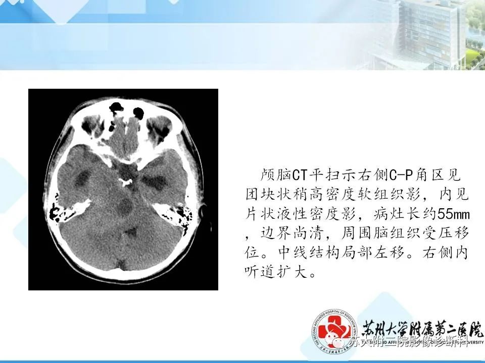 影像PPT - 【PPT】脑桥小脑角区常见占位性病变-15