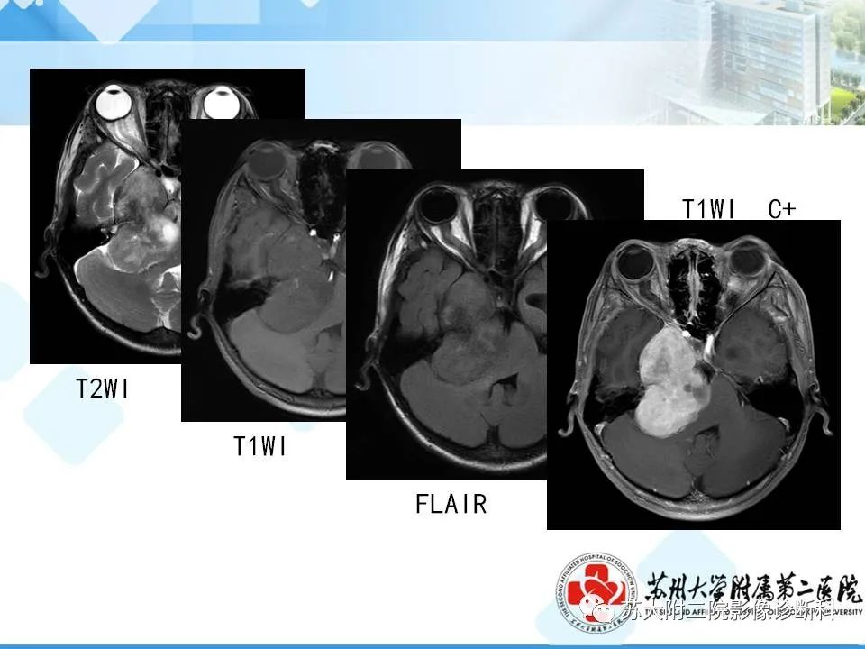 影像PPT - 【PPT】脑桥小脑角区常见占位性病变-16