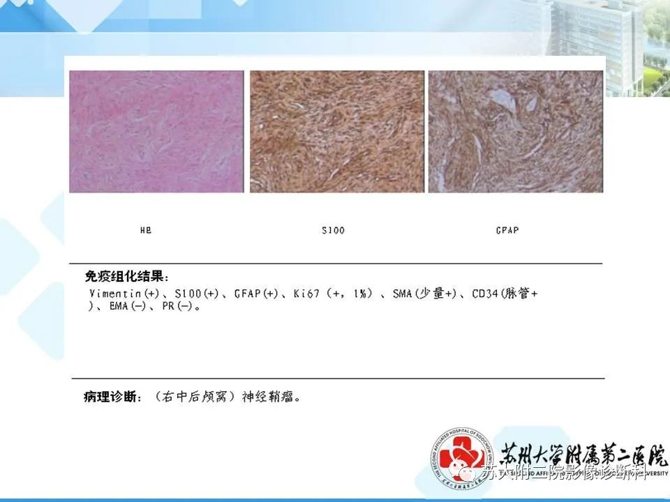 影像PPT - 【PPT】脑桥小脑角区常见占位性病变-18