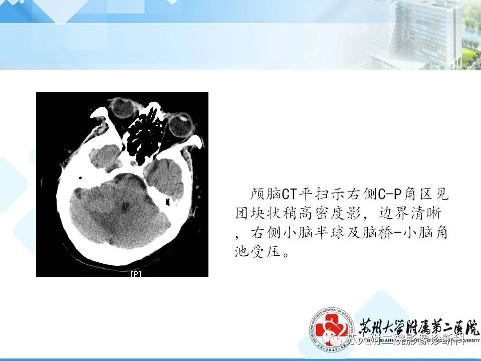 影像PPT - 【PPT】脑桥小脑角区常见占位性病变-23
