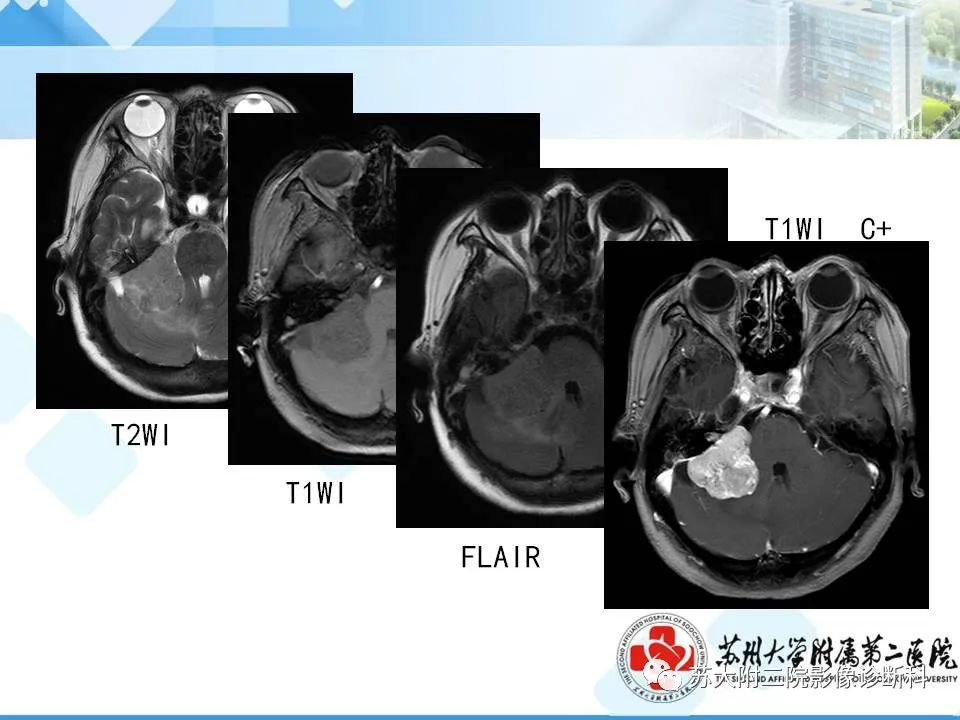 影像PPT - 【PPT】脑桥小脑角区常见占位性病变-24