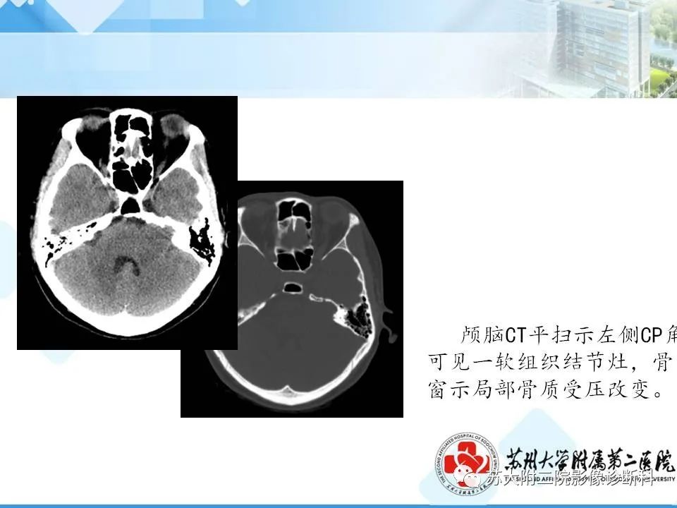 影像PPT - 【PPT】脑桥小脑角区常见占位性病变-30