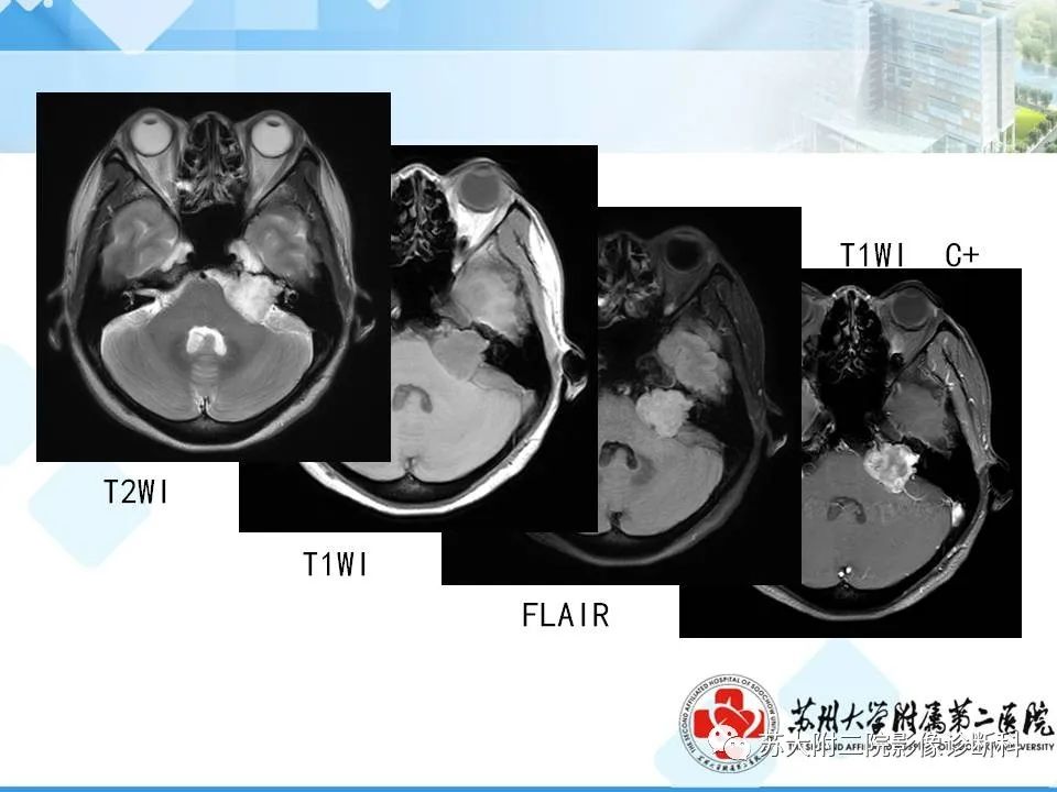 影像PPT - 【PPT】脑桥小脑角区常见占位性病变-31