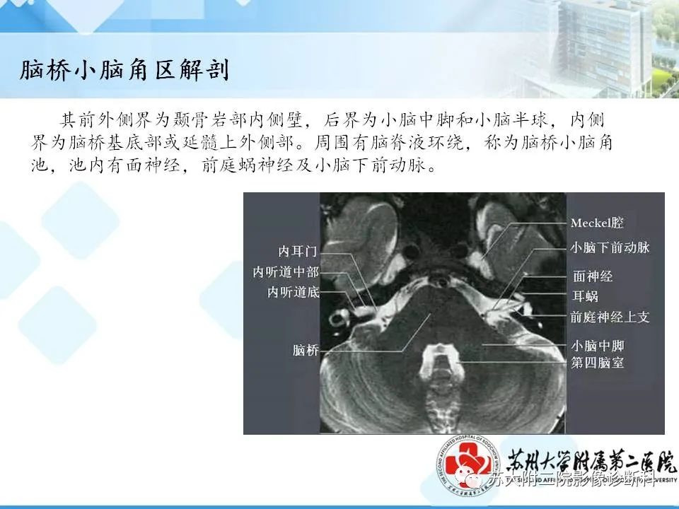 影像PPT - 【PPT】脑桥小脑角区常见占位性病变-35