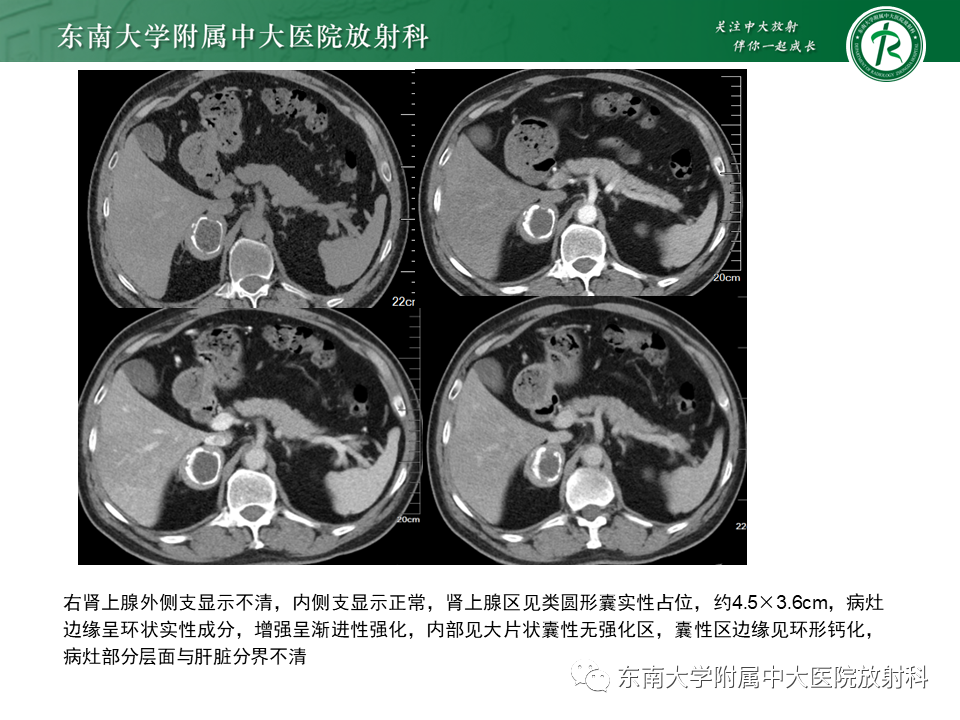 影像PPT - 【PPT】肾上腺嗜铬细胞瘤CT诊断与鉴别诊断-2 影像PPT - 【PPT】肾上腺嗜铬细胞瘤CT诊断与鉴别诊断-2