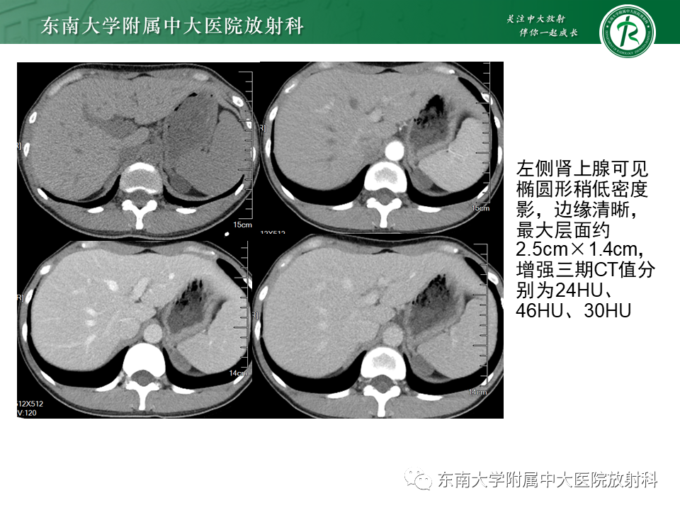 影像PPT - 【PPT】肾上腺嗜铬细胞瘤CT诊断与鉴别诊断-13 影像PPT - 【PPT】肾上腺嗜铬细胞瘤CT诊断与鉴别诊断-13