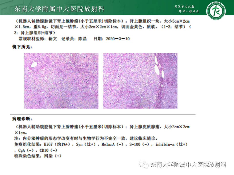 影像PPT - 【PPT】肾上腺嗜铬细胞瘤CT诊断与鉴别诊断-14 影像PPT - 【PPT】肾上腺嗜铬细胞瘤CT诊断与鉴别诊断-14