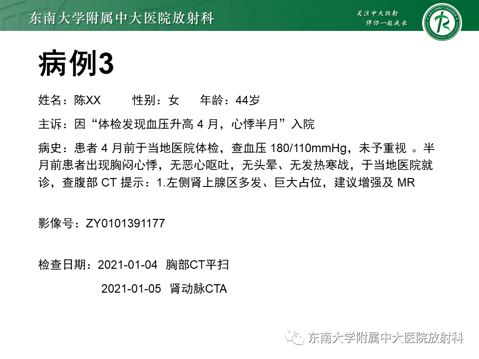 影像PPT - 【PPT】肾上腺嗜铬细胞瘤CT诊断与鉴别诊断-17 影像PPT - 【PPT】肾上腺嗜铬细胞瘤CT诊断与鉴别诊断-17