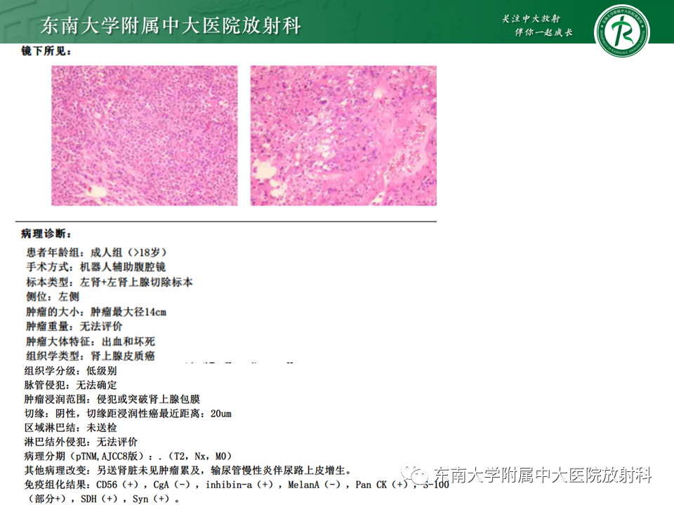 影像PPT - 【PPT】肾上腺嗜铬细胞瘤CT诊断与鉴别诊断-19 影像PPT - 【PPT】肾上腺嗜铬细胞瘤CT诊断与鉴别诊断-19