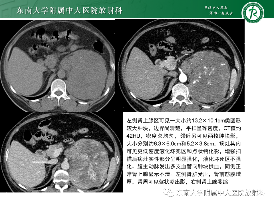 影像PPT - 【PPT】肾上腺嗜铬细胞瘤CT诊断与鉴别诊断-18 影像PPT - 【PPT】肾上腺嗜铬细胞瘤CT诊断与鉴别诊断-18