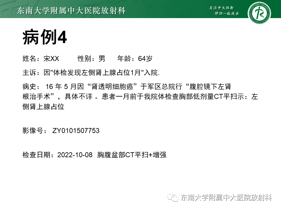 影像PPT - 【PPT】肾上腺嗜铬细胞瘤CT诊断与鉴别诊断-21 影像PPT - 【PPT】肾上腺嗜铬细胞瘤CT诊断与鉴别诊断-21