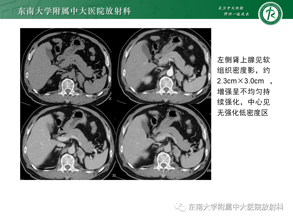 影像PPT - 【PPT】肾上腺嗜铬细胞瘤CT诊断与鉴别诊断-22 影像PPT - 【PPT】肾上腺嗜铬细胞瘤CT诊断与鉴别诊断-22