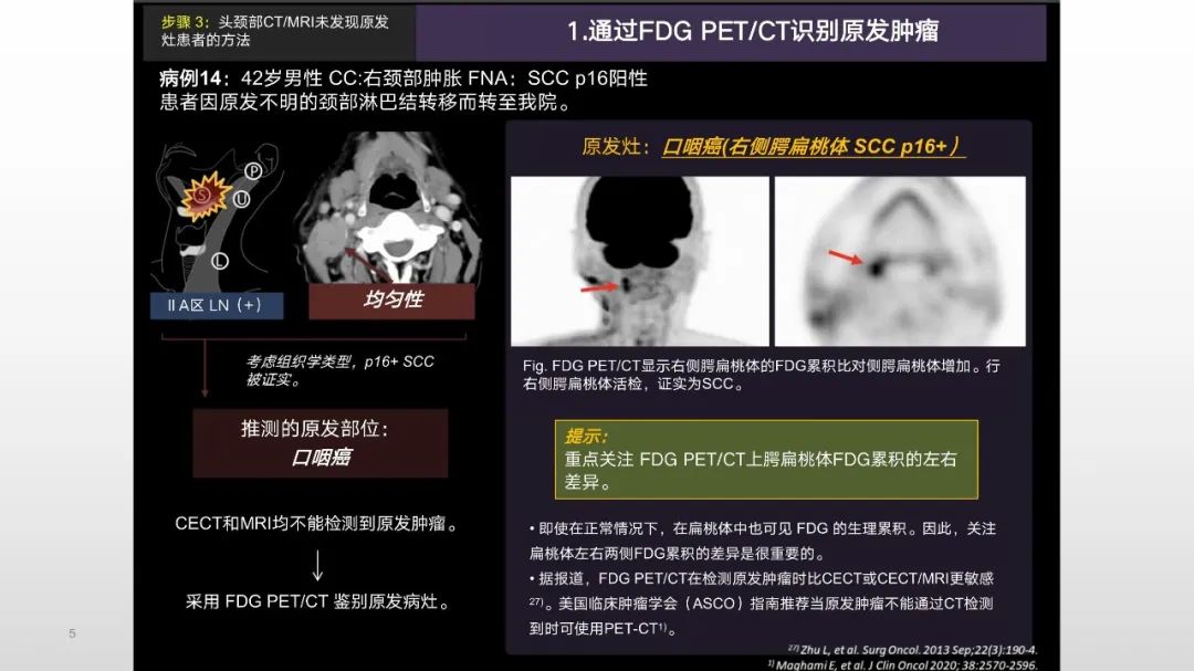 影像PPT - 【PPT】原发肿瘤在哪里？不明原发肿瘤颈部淋巴结转移的影像学检查方法-3