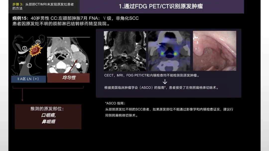 影像PPT - 【PPT】原发肿瘤在哪里？不明原发肿瘤颈部淋巴结转移的影像学检查方法-5