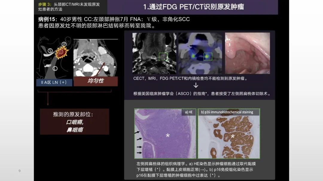 影像PPT - 【PPT】原发肿瘤在哪里？不明原发肿瘤颈部淋巴结转移的影像学检查方法-7