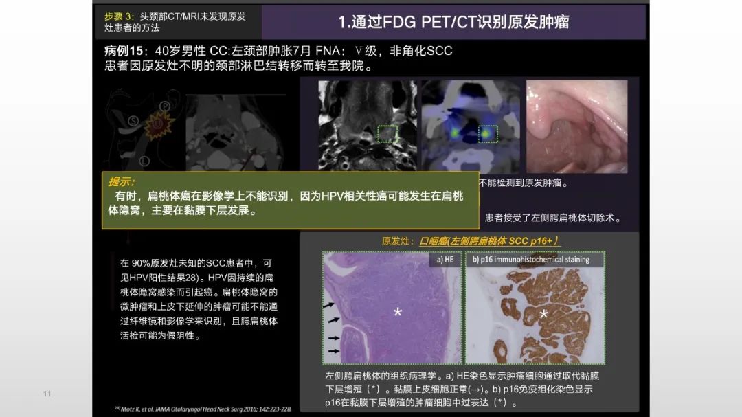 影像PPT - 【PPT】原发肿瘤在哪里？不明原发肿瘤颈部淋巴结转移的影像学检查方法-9