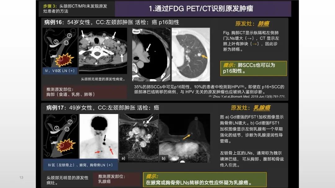 影像PPT - 【PPT】原发肿瘤在哪里？不明原发肿瘤颈部淋巴结转移的影像学检查方法-11