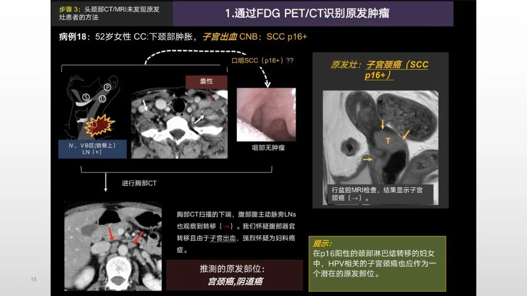 影像PPT - 【PPT】原发肿瘤在哪里？不明原发肿瘤颈部淋巴结转移的影像学检查方法-13